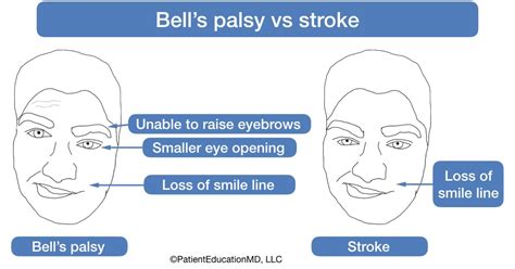 bell's palsy forehead vs stroke