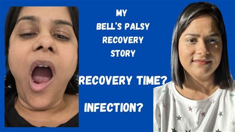 bell's palsy healing time