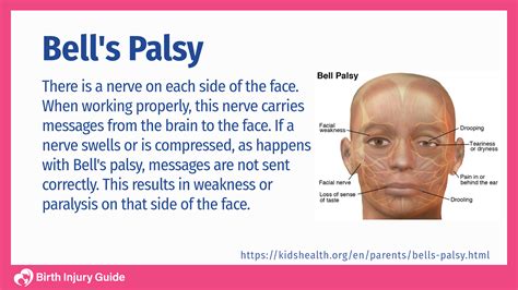 bell's palsy in infant