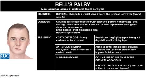 bell's palsy medication treatment