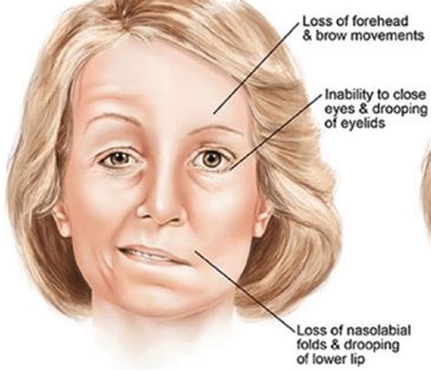 bell's palsy on both sides of face