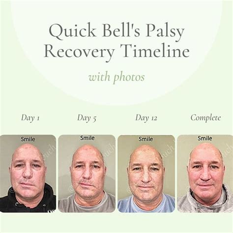 bell's palsy quickest recoveries