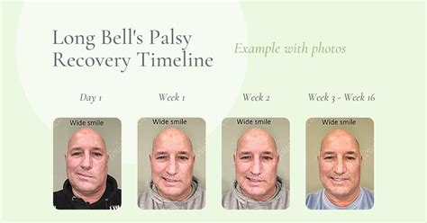 bell's palsy recovery stages