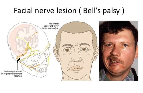 bell's palsy symptoms in cats