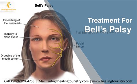 bell's palsy treatment uptodate