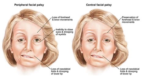 bell's palsy vs stroke eyebrow raise