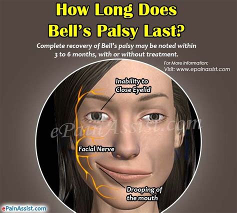 bell palsy how long does it last