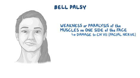 bell palsy is characterized by