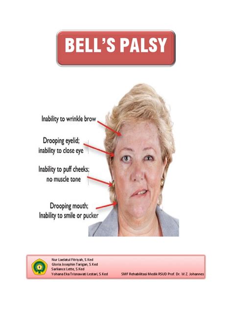 bells palsy gpnotebook