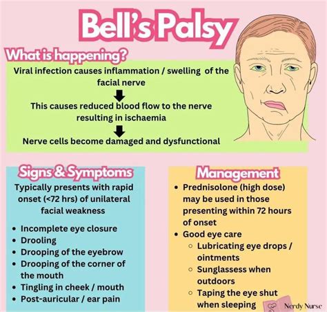 Bells Palsy Tx