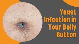 belly button infection