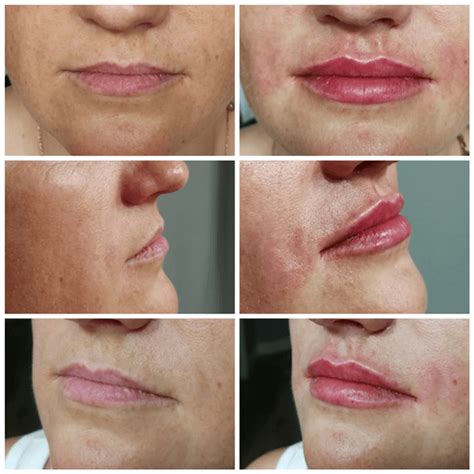 belotero filler before and after