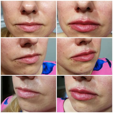 belotero lips before and after