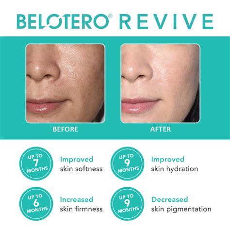 belotero revive skin booster