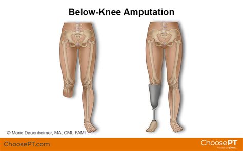 Understanding Life After a Below Knee Amputation Procedure