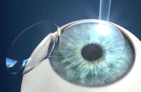 benefits of lasik laser vision correction