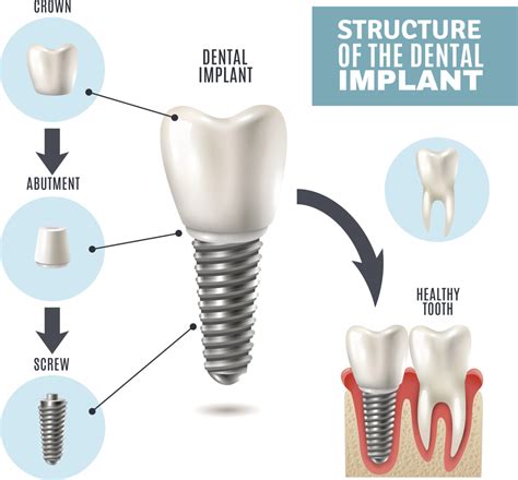 benefits of newest dental implants