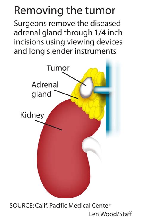 benign adrenal gland tumor treatment