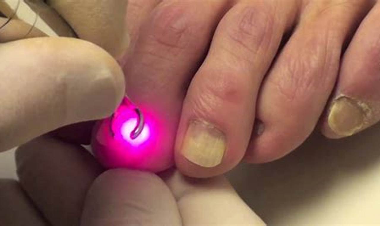 Best at Home Nail Fungus Laser Treatment