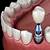 best dental implants cost near me