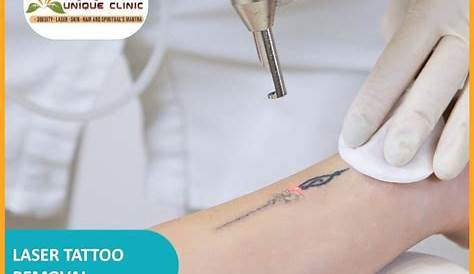 Best Laser Tattoo Removal In Nagpur Nagpur Maharashtra Top 110 + Stamp