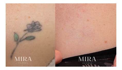 Best Laser Tattoo Removal Perth At MIRA Clinic West MIRA Clinic