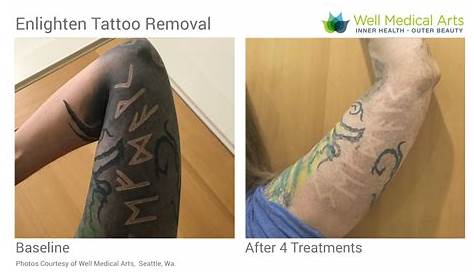 Best Laser Tattoo Removal Seattle The Chicago References Marlinestabs