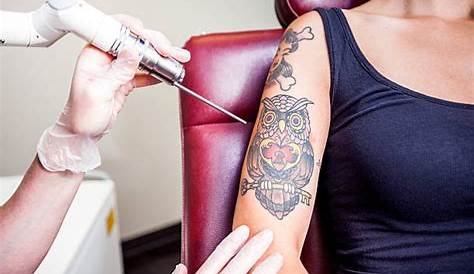 Best Places for Tattoo Removal in London LDNfashion