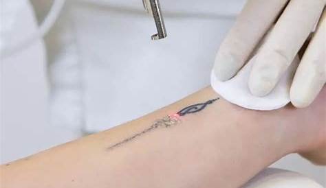 Best Tattoo Removal In Dubai For Green k Laser Skin Care Clinic