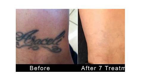 Best Tattoo Removal In Los Angeles MEDCOO