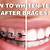 best teeth whitening after braces