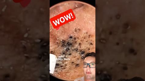 best blackhead pop
