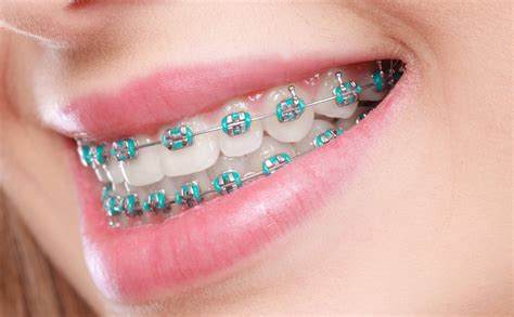Best Braces Dentist