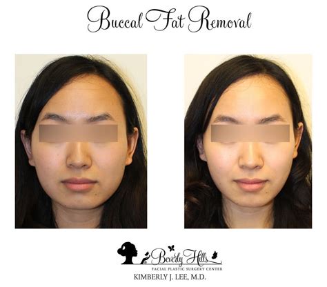 best buccal fat removal surgeon los angeles