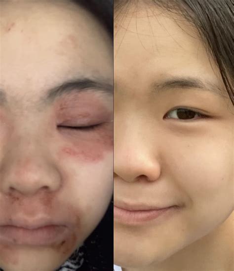 best cream for eczema on face reddit