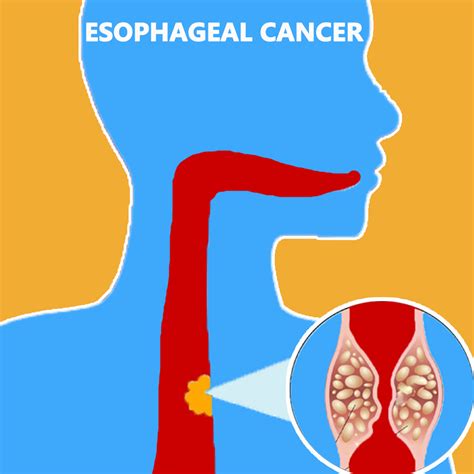 best esophageal cancer centers