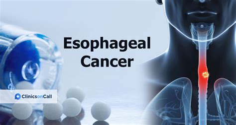 best esophageal cancer treatment