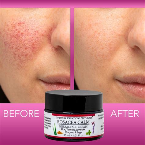 best facial cream for rosacea sensitive skin