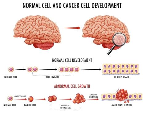 best glioblastoma treatment in the world