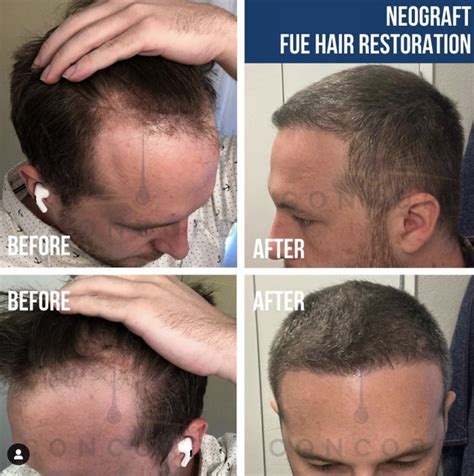 Hair Regrowth For Men The BEST Men's Hair Loss Products