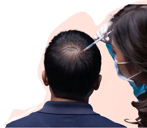 best hair transplant doctor in bangalore