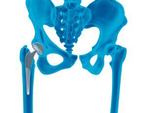 best hip replacement surgeons in phoenix az