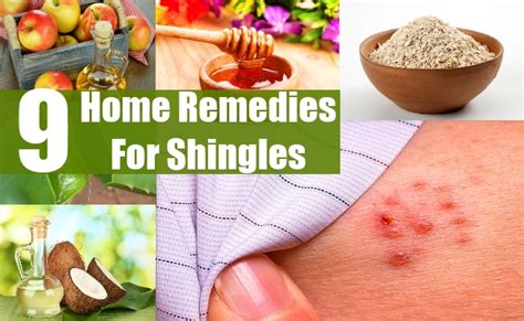 best home remedy for shingles