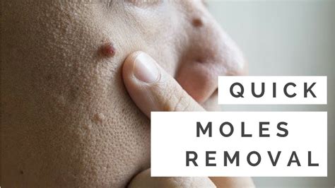 best mole removal home remedy