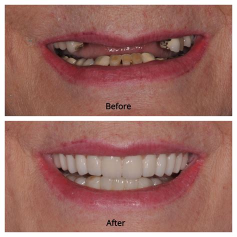 best rated dental implants near me