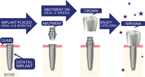 best rated for dental implants