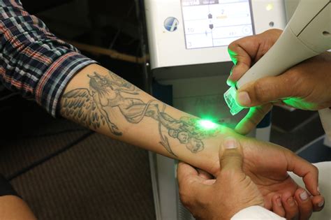 best tattoo removal california city