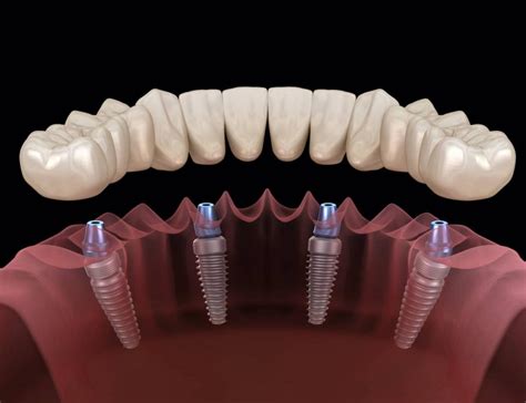 best tooth implant dentists in uk