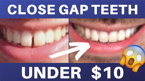 best way to close gaps in teeth