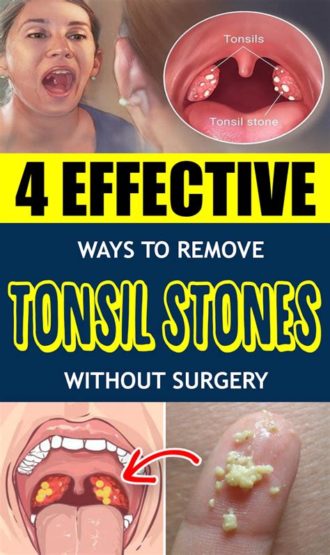 best way to get rid of tonsil stones for good